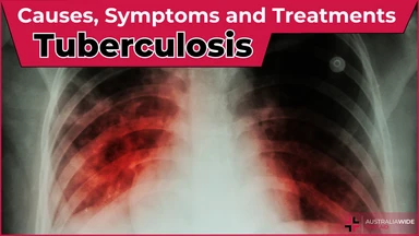 Tuberculosis article header – First Aid Article in Canning Vale
